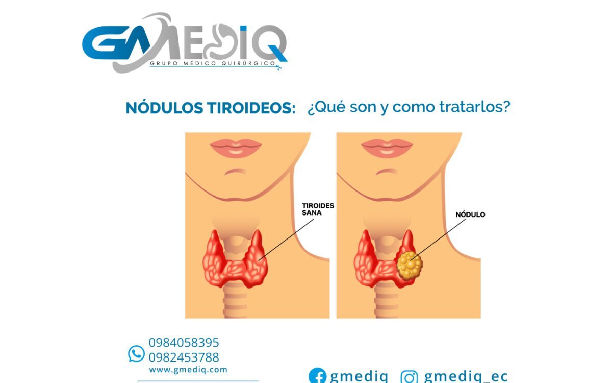 “NÓDULOS TIROIDEOS: ¿QUÉ SON Y COMO TRATARLOS?”