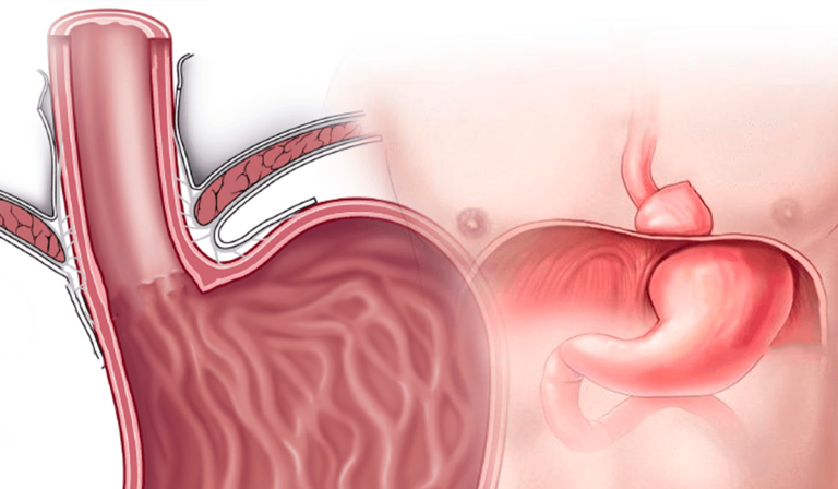 Cirugía antirreflujo por hernia del hiato en quito y ambato