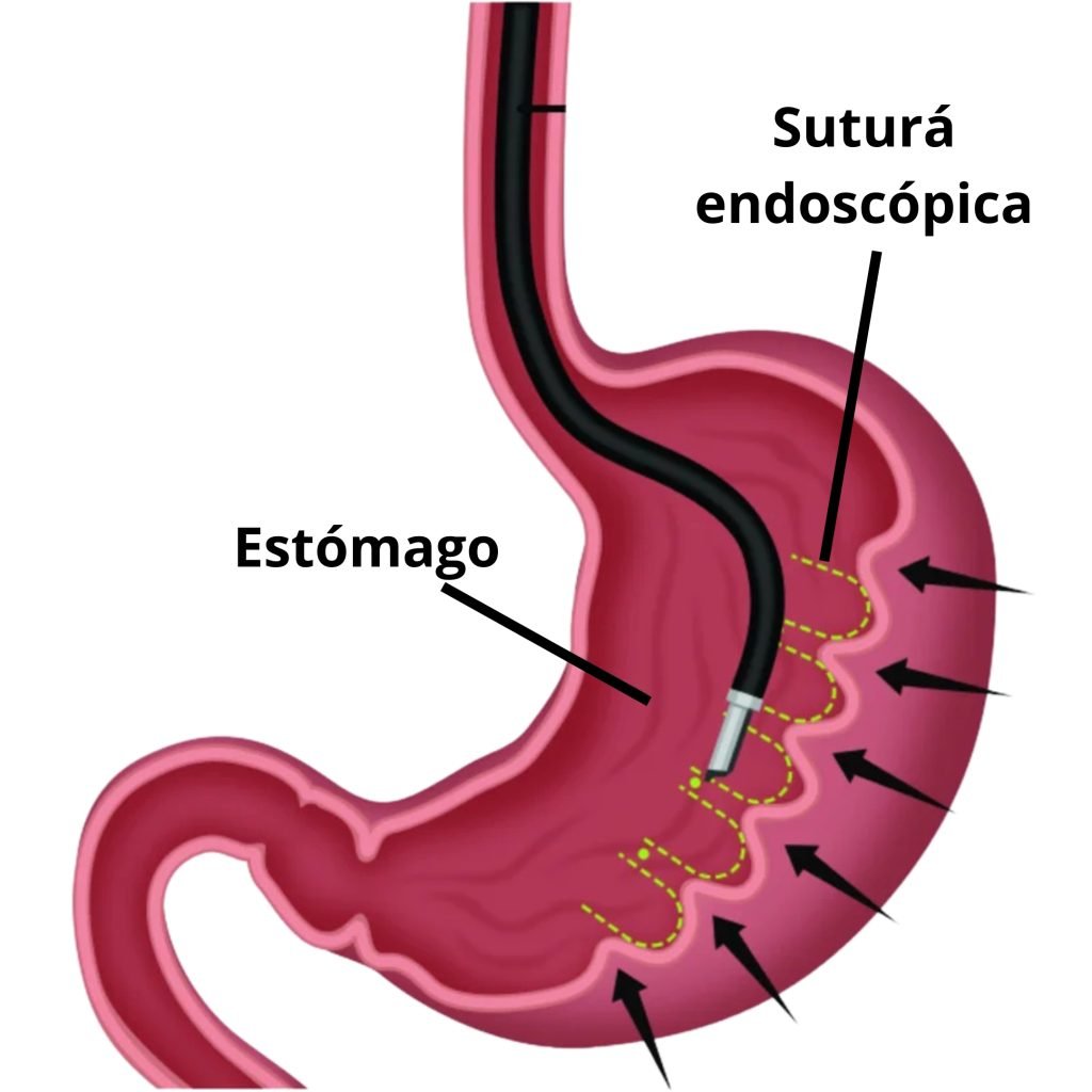 Como se realiza manga gástrica endoscopica