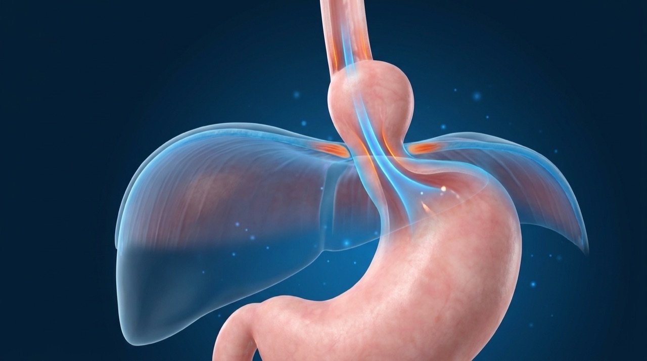 Ilustración 3D de una hernia hiatal a través del diafragma